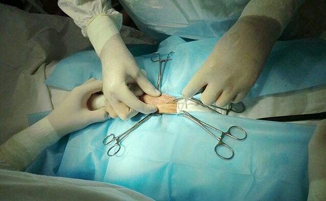 Reproductive organ surgery helps increase its size