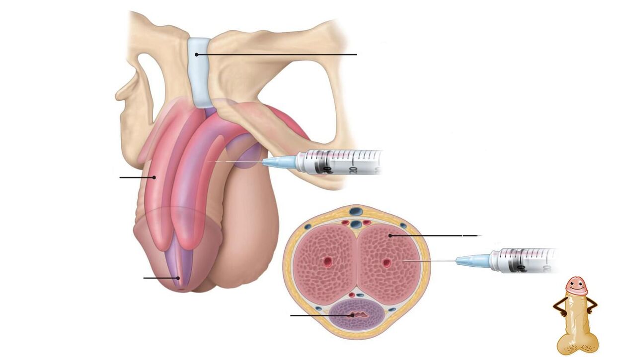 hyaluronic acid injections to enlarge the penis